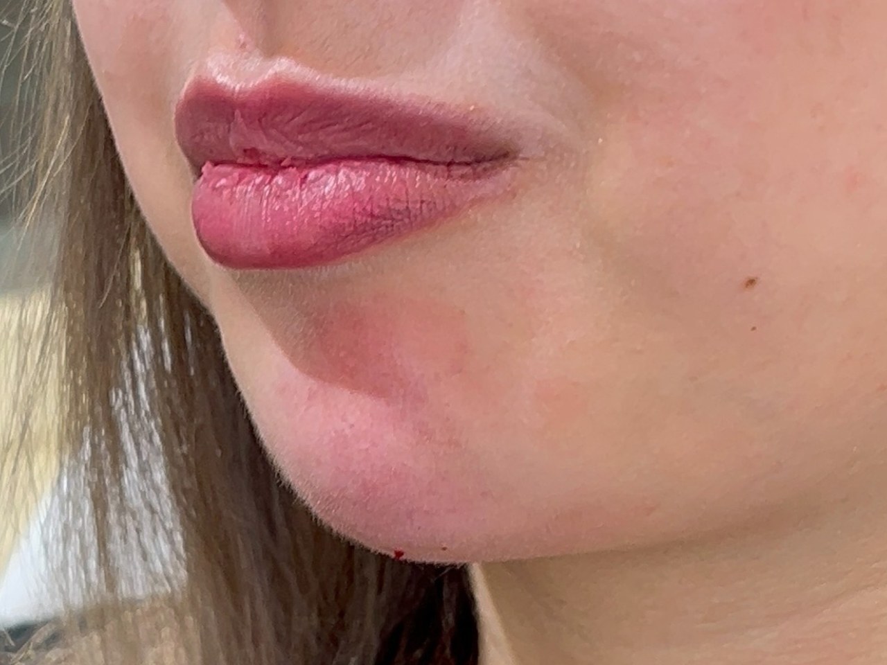 نتيجة علاج في Natour Clinic 10